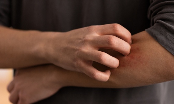 Alergia na nikiel – objawy na dłoniach i bezpieczne sztućce w restauracji